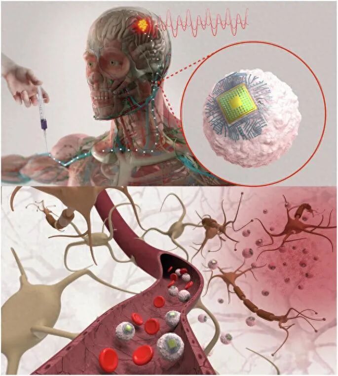 MIT发明“可注射”脑机芯片 可治老年痴呆症 MIT发明“可注射”脑机芯片 可治老年痴呆症